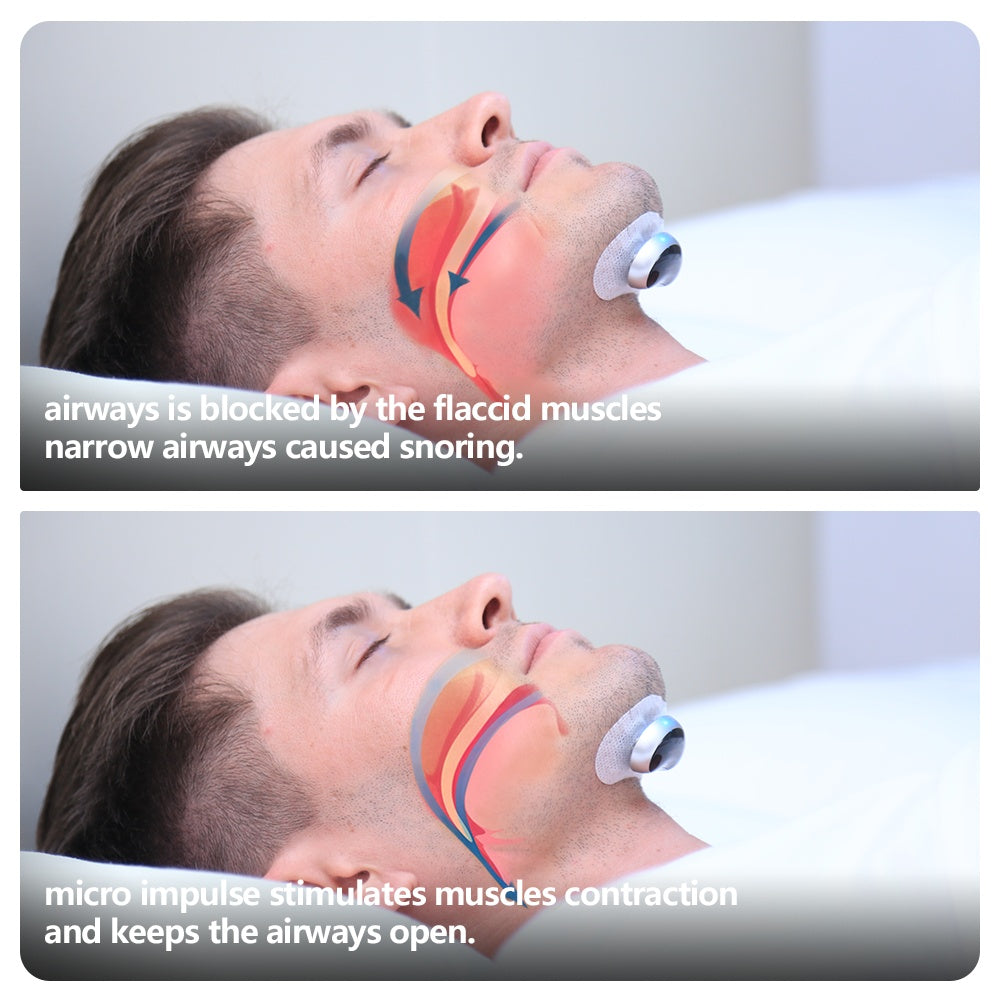 Smart Anti Snoring Device Electronic Muscle Stimulator - EBS PLATFORM INC.